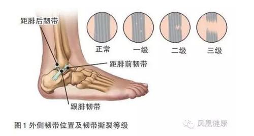 图片来源:网络如何辨别脚踝损伤的轻重程度大家都有过崴脚的经历,有的