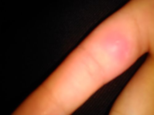 手指红肿还很疼已经有两三天了