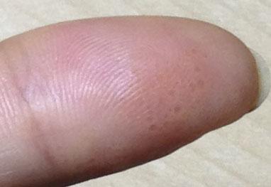 大拇指指腹上的表皮下长了一些小小的水泡状