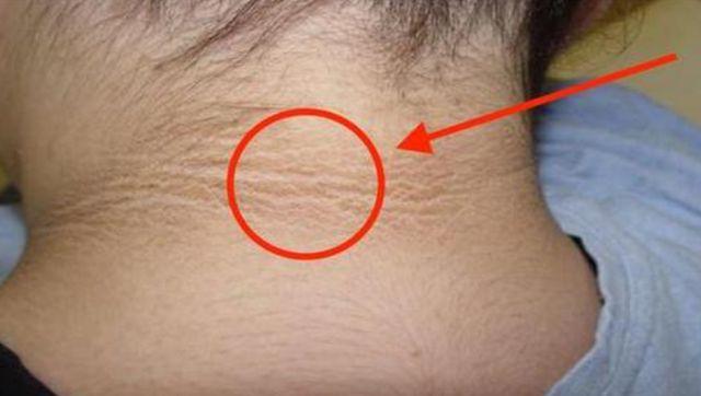 脖子上会出现一圈或者是两圈黑色的印记,洗不掉,叫做黑色棘皮症.