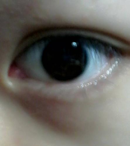 问:右眼角内红肿,偶尔有痒 涩的感觉,但不感觉明显,左右眼比较眼角