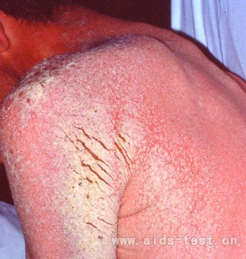 皮肤细菌感染引起的皮疹,也是艾滋病初期症状.