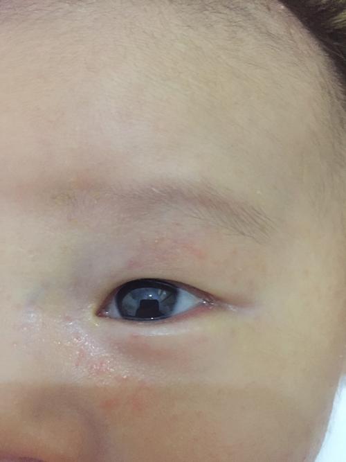 6,宝宝眼睛流眼泪的原因 鼻泪管阻塞产生眼泪的腺体称为ldquo泪腺