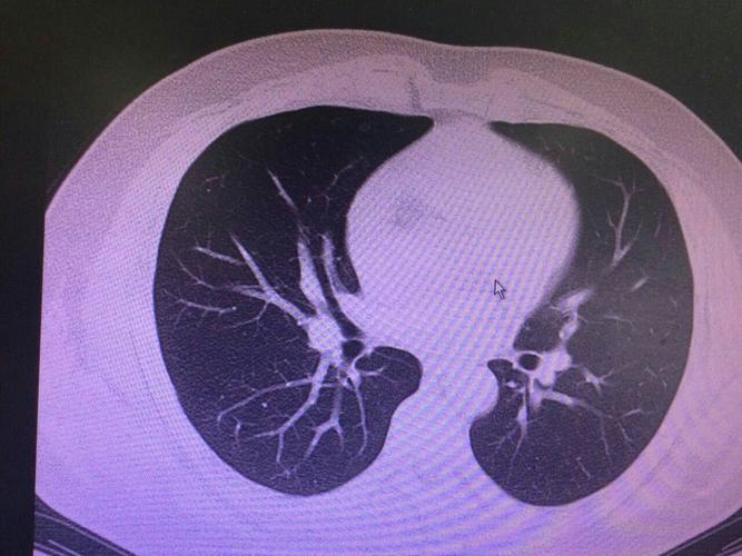 诊断肺隐球菌病,氟康唑治疗8月后复查影像学吸收