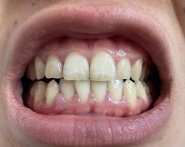请问牙齿上有白斑是什么情况呢