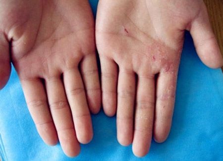 皮肤性病科 皮肤科 手足癣 手足癣病因 4,由于手足癣具体一定的传染性