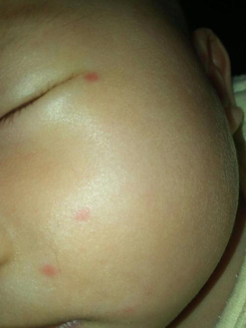 宝宝脸上长小红点点是怎么回事