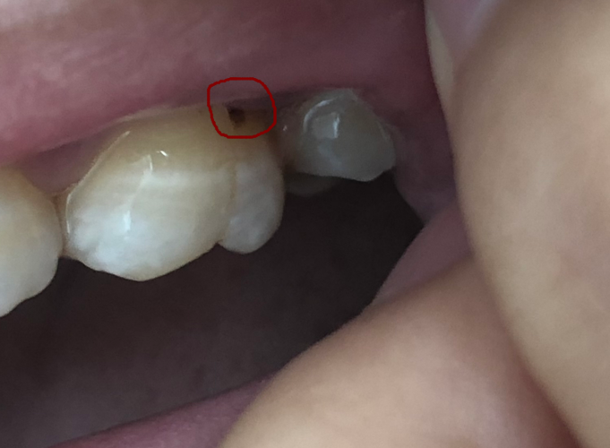今天刷牙特别酸,拍照发现牙上有个小洞,这应该怎么补呢?