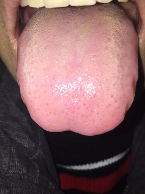 舌头下面起红点