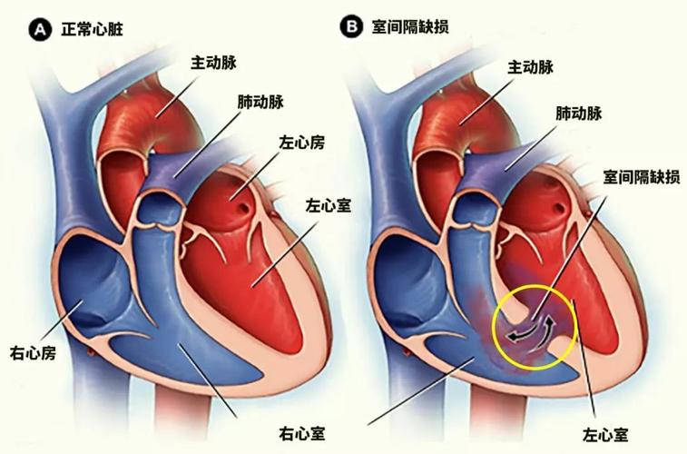 先天性心脏病指的则是胎儿期心脏及大血管发育异常所导致的先天性畸形