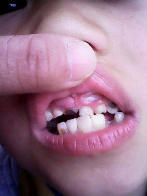 牙长在牙龈上面怎么办,儿子6岁了从小牙齿