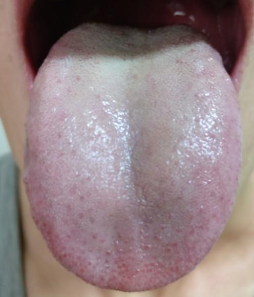 单纯你的描述和图片舌头舌苔的情况是存在肝火旺盛表现,阴虚火旺可能