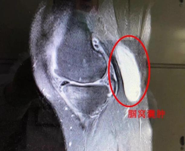 4个05cm微小切口的手术巧取膝关节腘窝囊肿