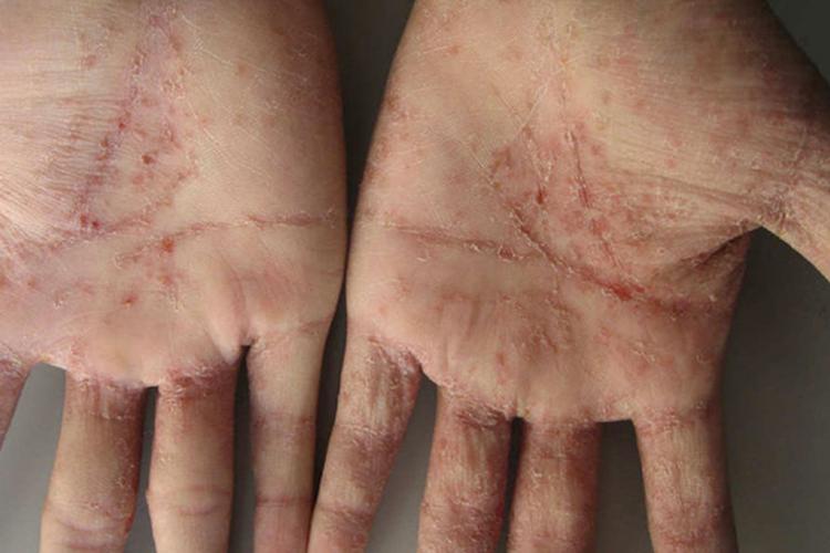 结痂型疥疮图病因疥疮是由疥螨寄生于皮肤导致的传染性皮肤病,主要