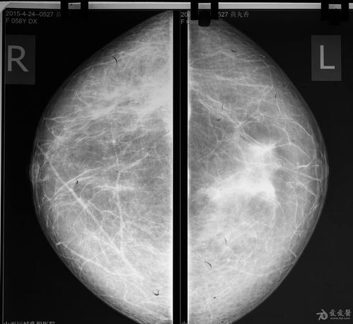 这个病人的乳腺钼靶怎样分析附乳腺彩超图
