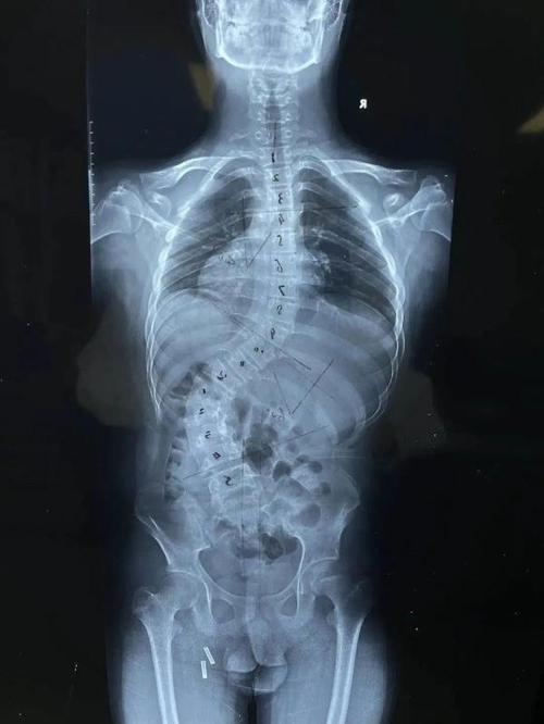 15岁男孩脊柱侧弯达60度医生提醒孩子出现此类情况需当心