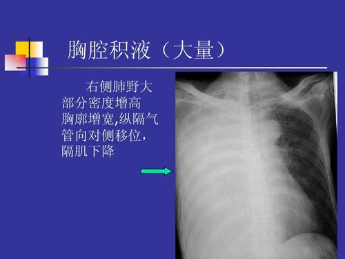 胸腔积液(大量) 右侧肺野大 部分密度增高 胸廓增宽,纵隔气 管向对侧