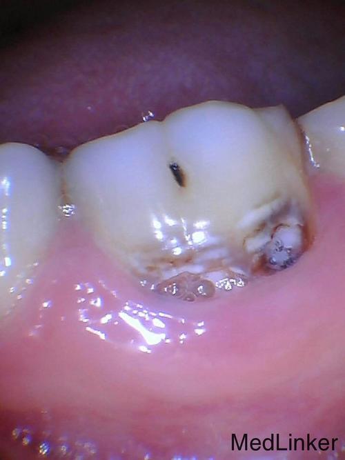 主诉 病史 左下后牙有牙洞,偶有冷刺激疼痛,刷牙不敢碰,要求治疗