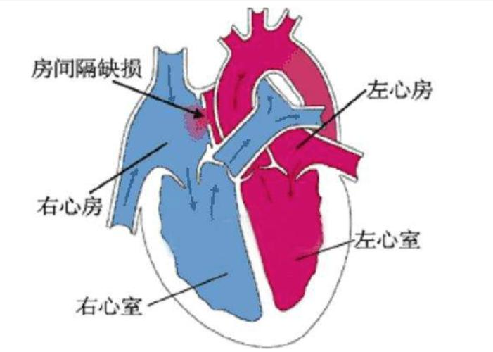 成人先天性心脏病管理指南房间隔缺损和肺静脉异常连接