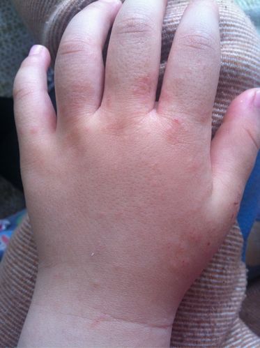 孩子手上长湿疹了能不能打预防针啊?