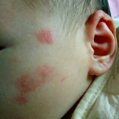宝宝快一个月了,脸上被蚊子咬后出现了红红的一片.