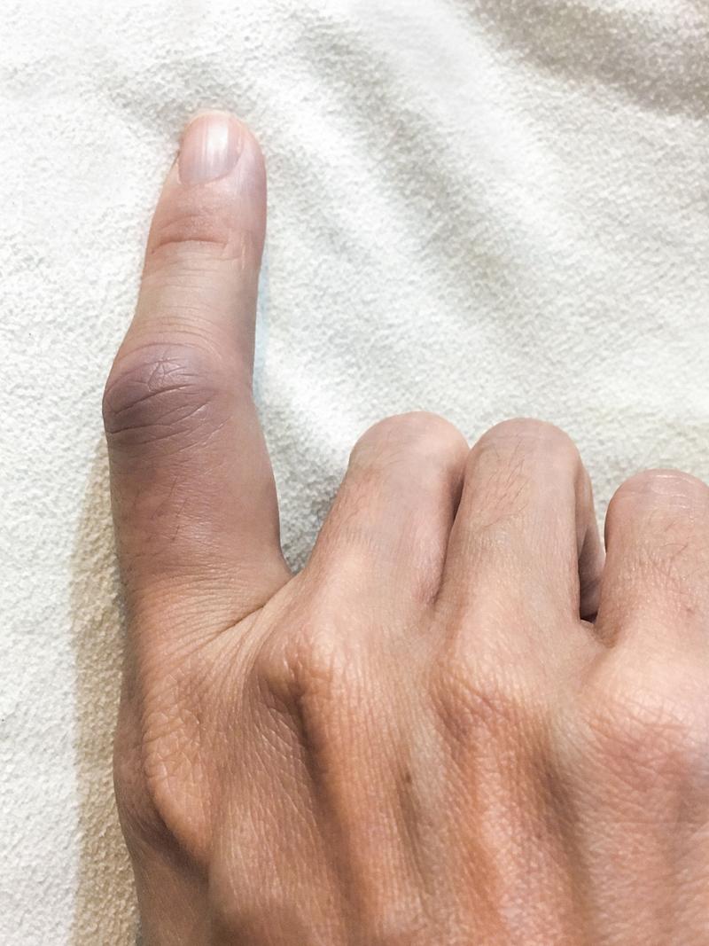 手指关节肿胀痛是什么原因引起的?