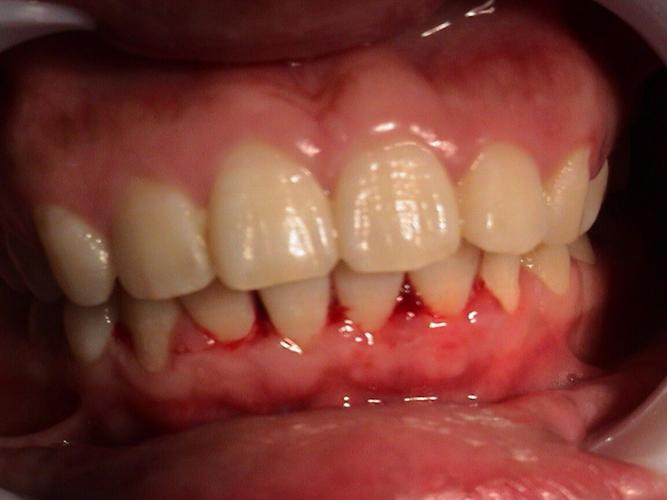 治疗牙龈出血多少钱?