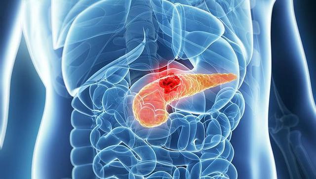 而正是由于其位置隐蔽,胰腺癌症状很容易与胃部,黄疸等疾病混淆.