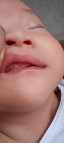 三十五天的宝宝牙龈上长了个白色的脓包疮一样的东西要紧吗?