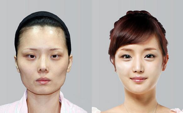 韩式长曲线改脸型利用韩式微创手术来改变天生不**脸型的整形手术