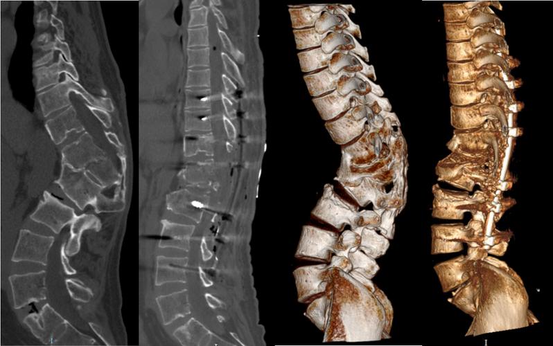 病例分享:脊柱后凸畸形矫形术