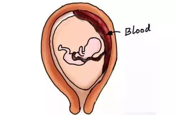 谁能想到孕妇一个喷嚏腹中胎儿差点没了