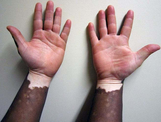 vitiligo often starts off affecting extremities such