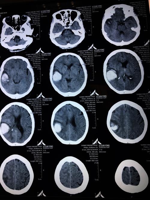 患者:李俊英,女,69岁,突发头痛3小时于6月22日17时入院,诊断右侧顶叶