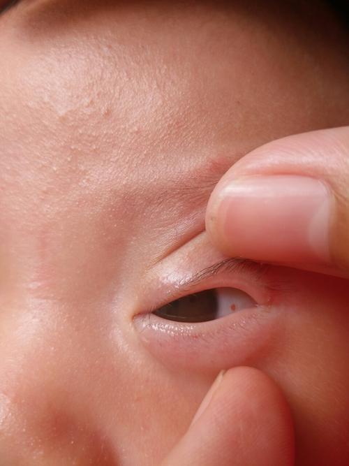 两个半月宝宝左眼眼白里面有一个小红点,脸上也有些,比眼睛里的小