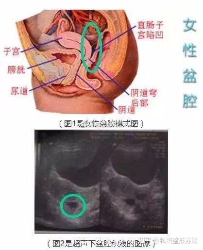盆腔积液的位置多发生在 子宫直肠陷凹等盆腔内位置较低处,妇科常用的