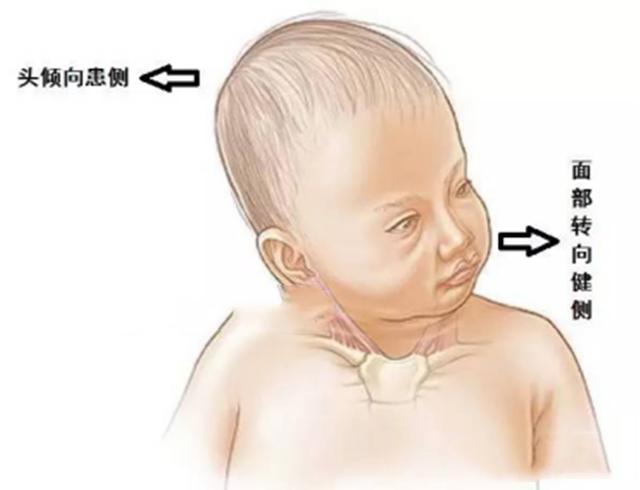 婴儿斜颈颈部特征照片