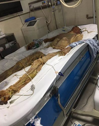 24岁年轻儿子被烫成干尸不治身亡家属怒讨公道儿子死在广东美达公司