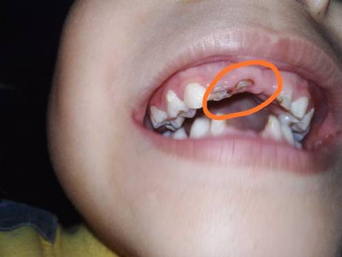 请问小孩5岁了,乳牙烂到牙根了,需要拔出来等待长新牙吗?在线等