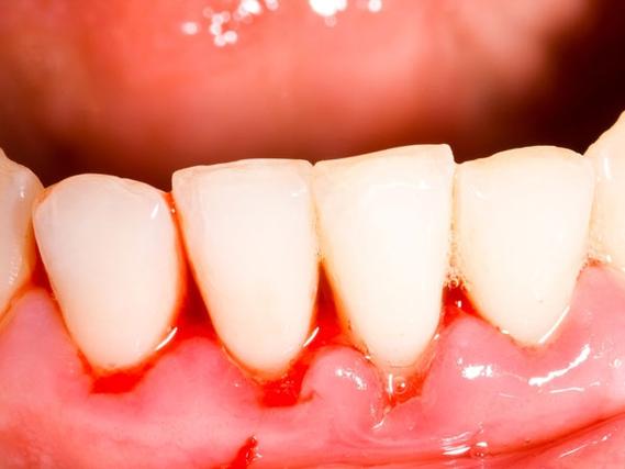 牙龈出血有哪些原因?