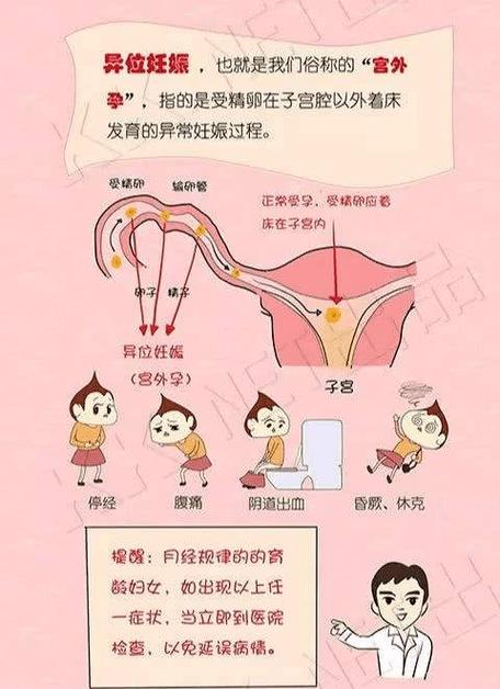 宫外孕的表现多样:典型症状为停经或不规则阴道出血(一般少于月经量)