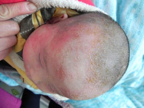 婴儿头上长湿疹怎么办,两大方法结合轻松痊愈
