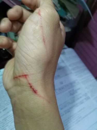 被我家的猫抓伤了怎么办