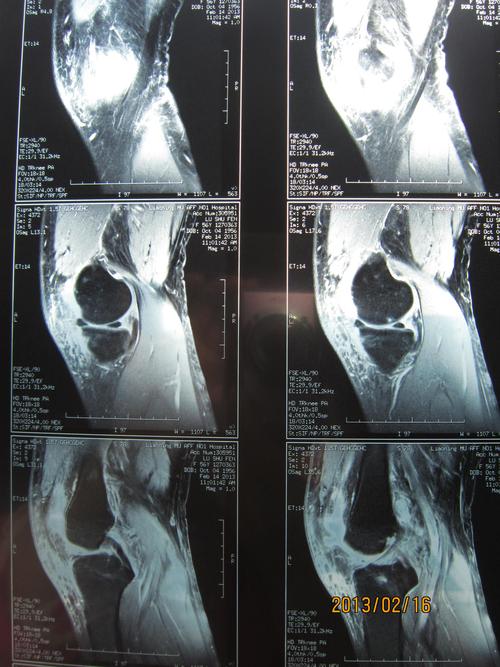 膝关节内侧半月板退变,膝关节少量积液,胫骨上端囊性病变,如何进行