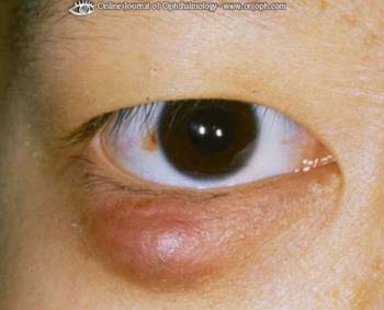 睑板腺囊肿和睑腺炎(针眼) - 眼部疾病 - msd诊疗手册专业版