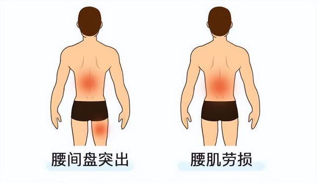 腰椎间盘突出与腰肌劳损有哪些不同如何快速区分看这里