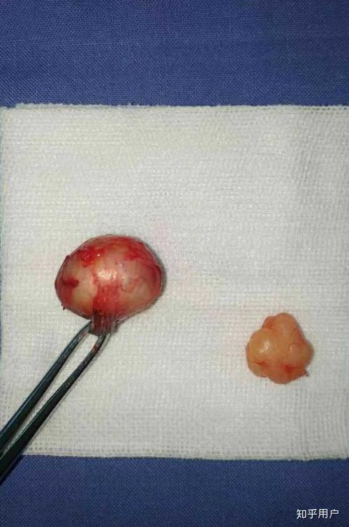 完整切除的皮脂腺囊肿(左),和脂肪瘤(右)