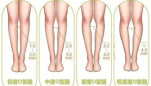 罗圈腿是怎么形成的