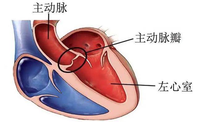主动脉瓣狭窄是指各种原因导致的主动脉瓣无法完全打开,阻碍心脏血液