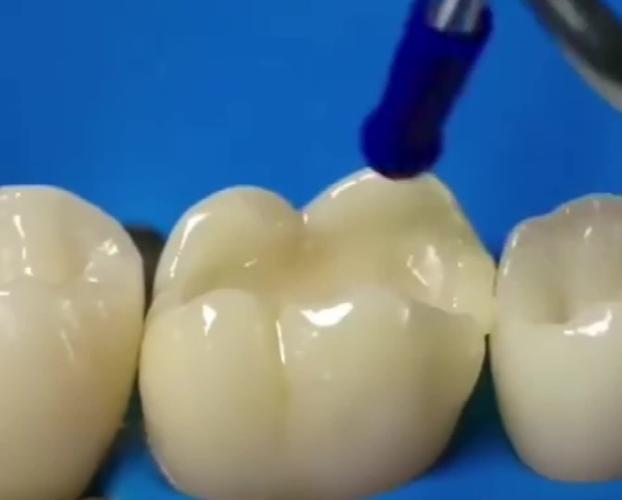 补牙3d动画演示全过程,看完你还觉得补牙简单吗?